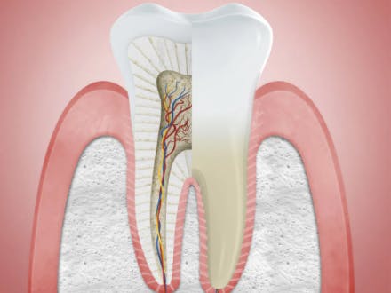 Abbildung von betroffenem Zahnfleisch mit PSI