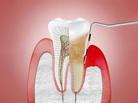 diş eti hastalıkları ve periodontitis