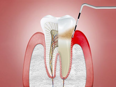 gingivitis tedavisi ve diş eti sorunları