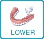 lower dentures