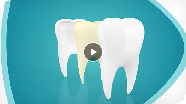 Video discussing how to help strengthen your tooth enamel so the yellow inside doesn’t show through