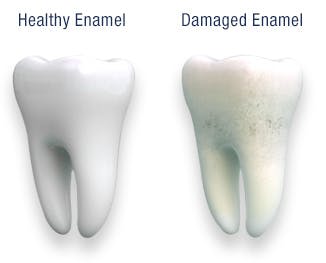 Comparison of Healthy Enamel and Damaged Enamel