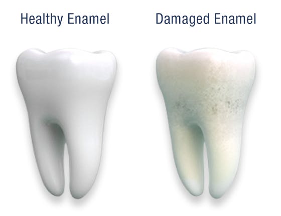 Comparison of Healthy Enamel and Damaged Enamel