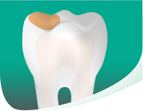 Tooth With Cavity Mobile