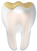 Tooth With Acid Erosion