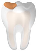 Tooth With Cavity Main