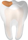 Tooth with a cavity