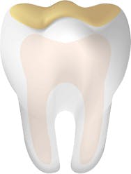 Tooth With Acid Erosion Mobile