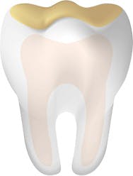 Tooth with a cavity