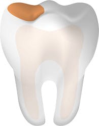 Tooth With Cavity Main Mobile