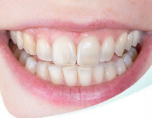 Person smiling with translucent teeth.