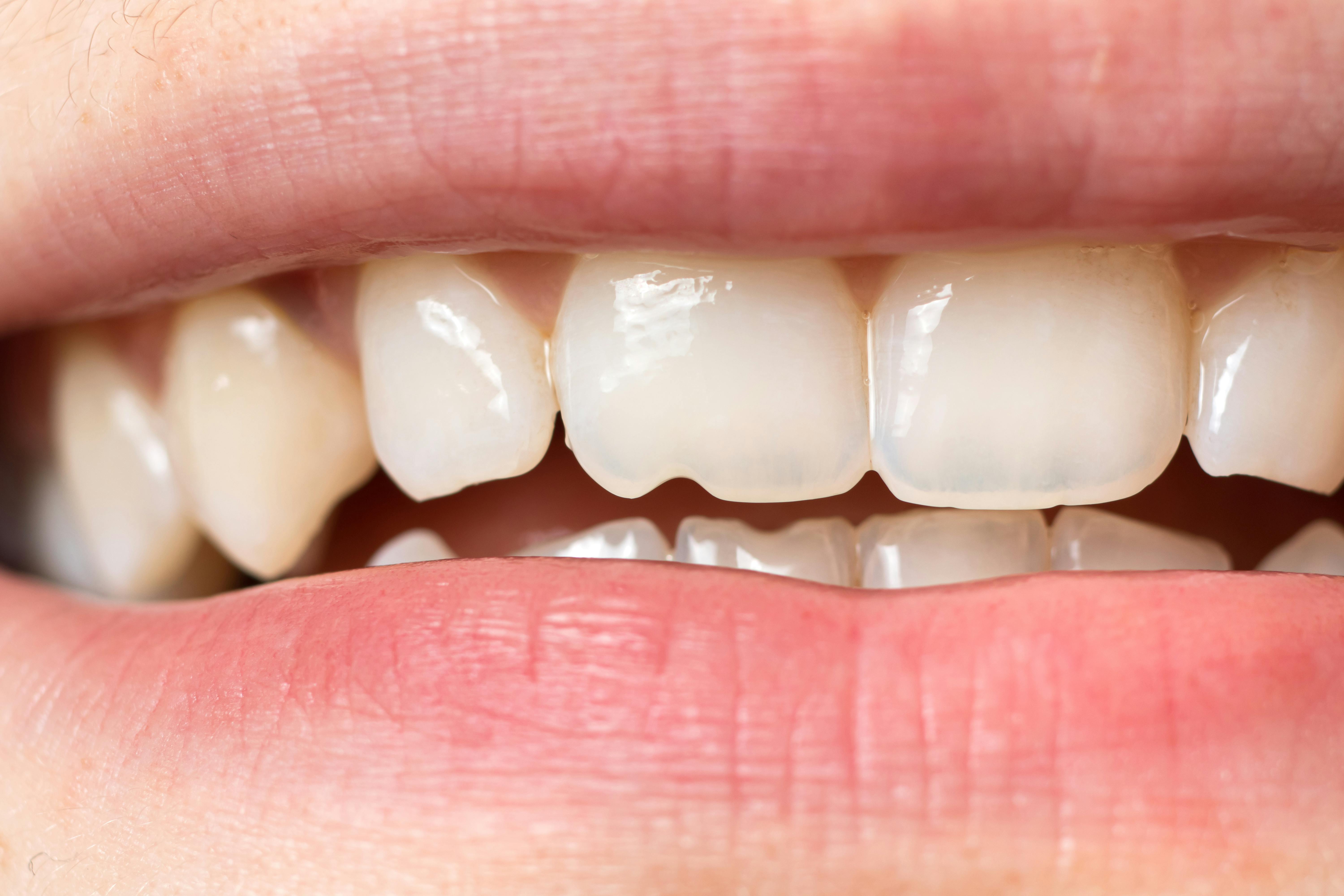 Mouth and teeth with damaged enamel