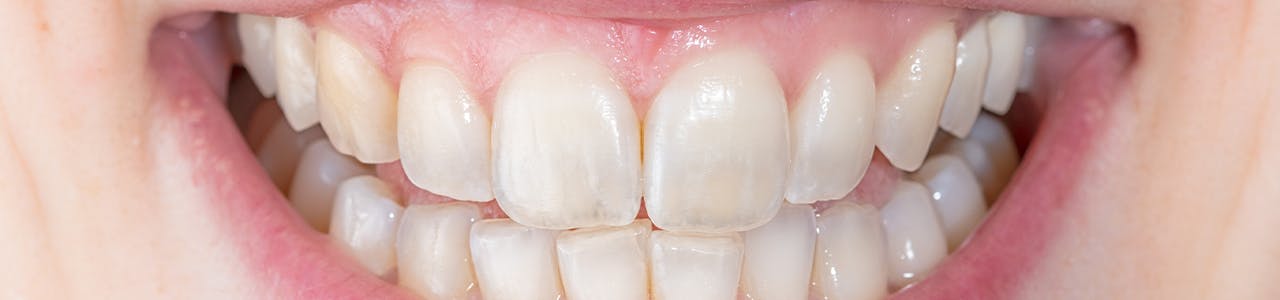 Person smiling with translucent teeth.