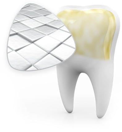 Enamel Wear Exposing Yellow Dentin Underneath