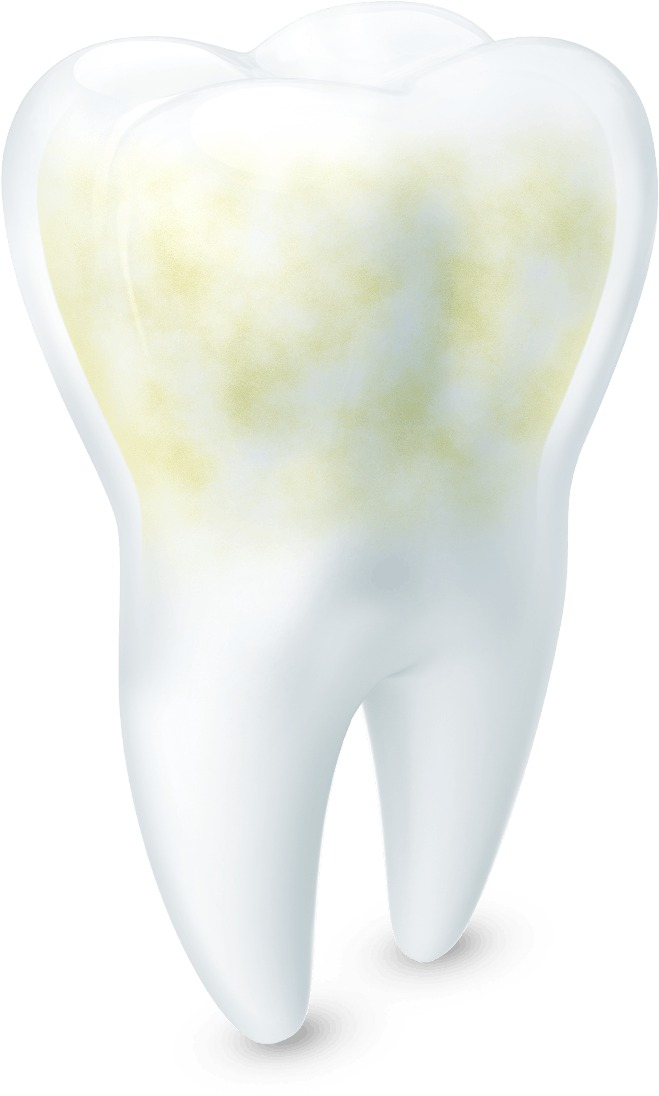 Image of a tooth with slight acid erosion