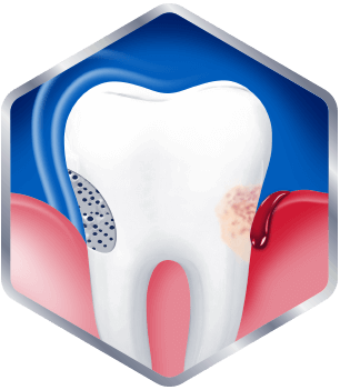Graphic of sensitive tooth with bleeding gums