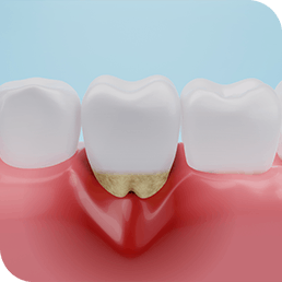 Image of recessed gum due to gum disease