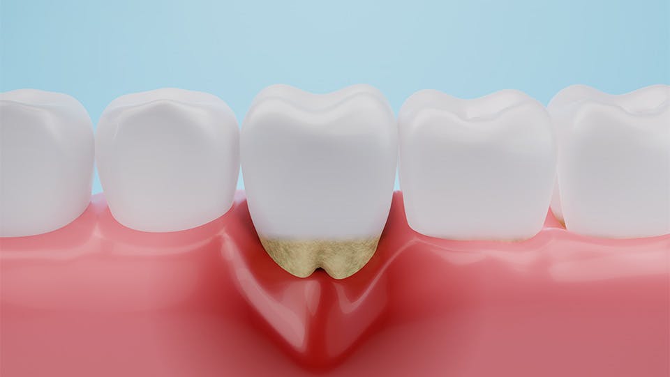 Image of recessed gum due to gum disease