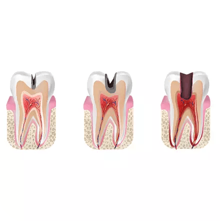 Illustration of the five stages of tooth decay