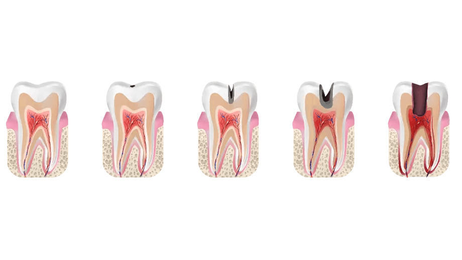 Illustration of the five stages of tooth decay