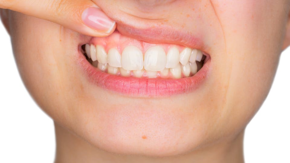 Woman pointing to gum and teeth