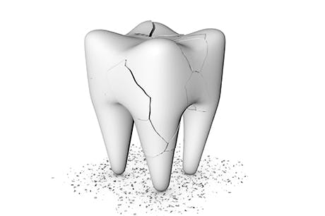 A Complete Guide to Temporary Tooth Fillings