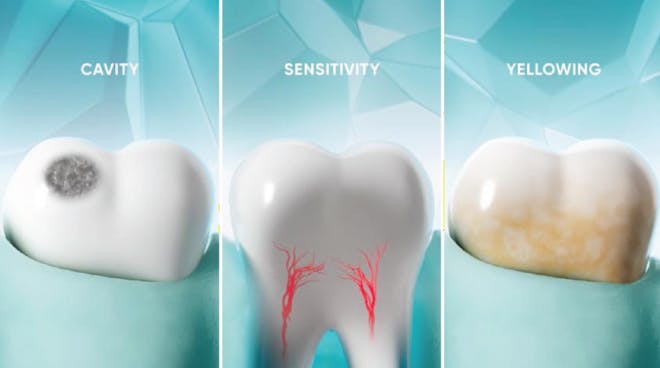 What happens when your tooth enamel starts to wear away? Cavity, Sensitivity, Yellowing What happens when your tooth enamel starts to wear away? Cavity, Sensitivity, Yellowing