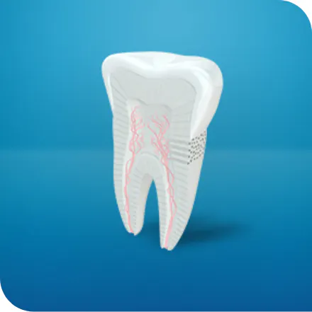 Tooth highlighting difference between cavity and sensitivity