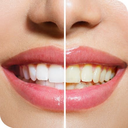 Woman Teeth Before After Whitening