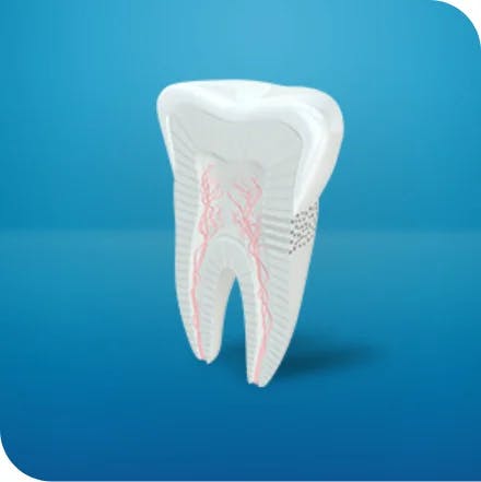 diente destacando la diferencia entre la cavidad y la sensibilidad