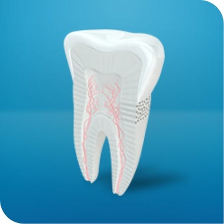 Kuva hampaasta korostomassa eroa reiän ja vihlonnan välillä