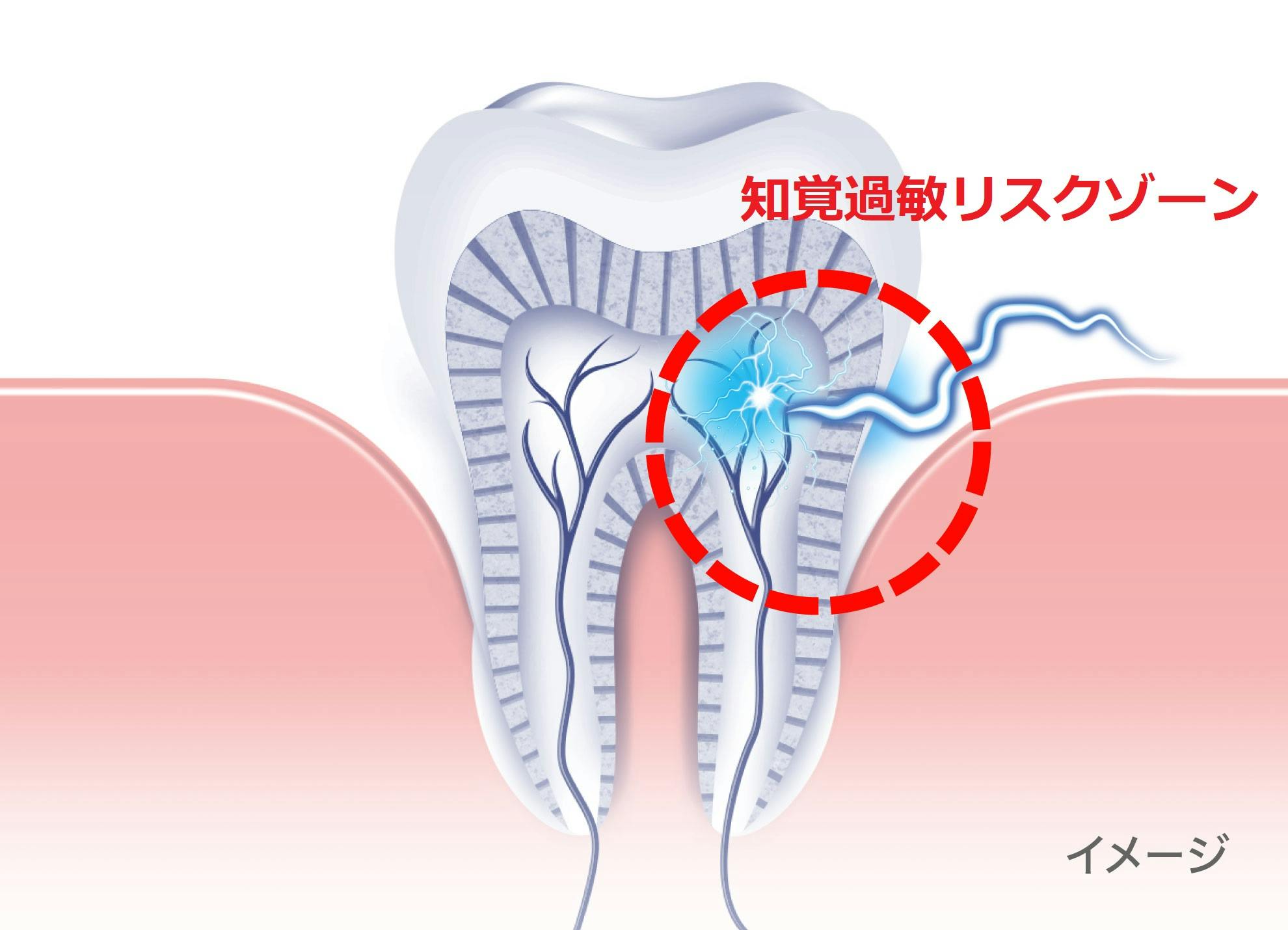 大人の約60%に知覚過敏リスクゾーン