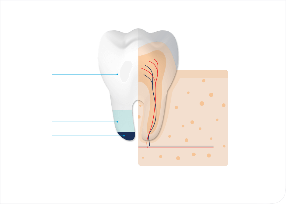 エナメル質：歯を保護している層