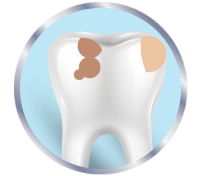Tooth that is dirty from plaque