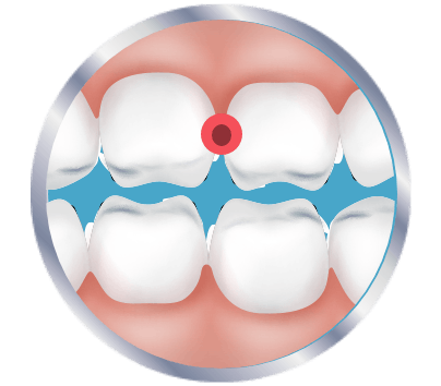 Ikon av tenner med en rød ring rundt et punkt i en tann