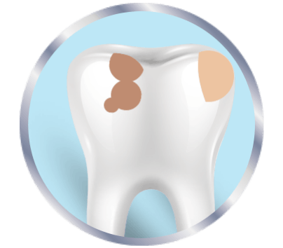 Dente com placa bacteriana