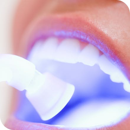 Sensitive teeth whitening