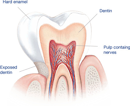 ما الذي يسبب الأسنان الحساسة