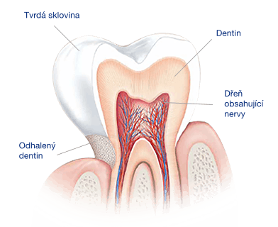 Co způsobuje citlivé zuby?