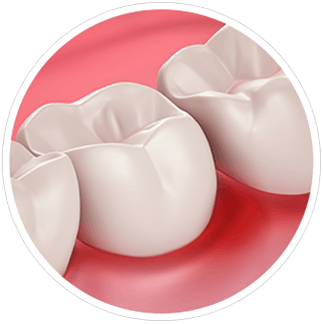Zahnfleischrückgang und Schmerzempfindlichkeit