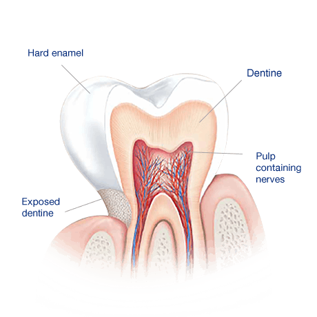 What Causes Sensitive Teeth?