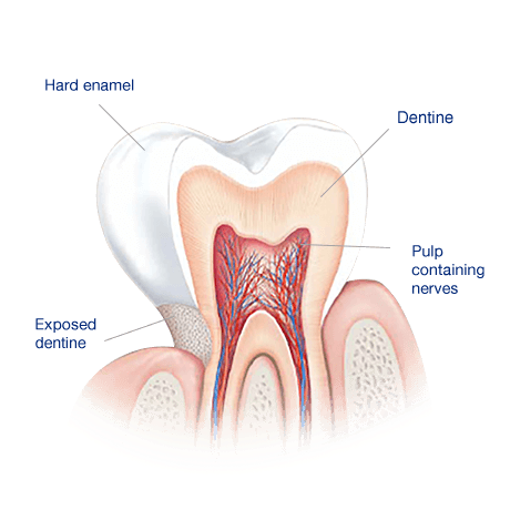 What Causes Sensitive Teeth? What Causes Sensitive Teeth?