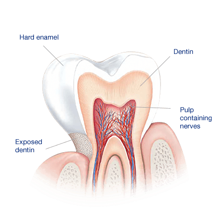 toothpaste for exposed dentin