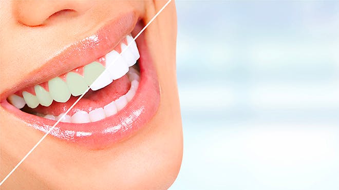 Tooth Whitening myths Header