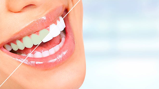 Print Tooth Whitening myths Header