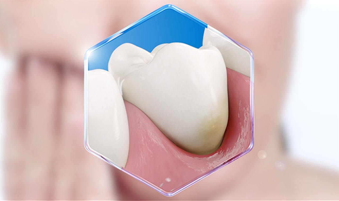 signs of gingivitis and inflamed gums