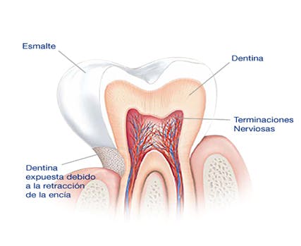 ¿Qué causa la sensibilidad dental?