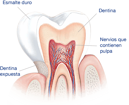 ¿Qué Causa la Sensibilidad Dental?