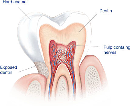 What Causes Sensitive Teeth? What Causes Sensitive Teeth?