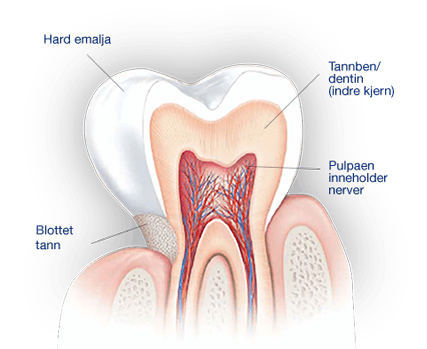 Hva forårsaker ising i tennene?